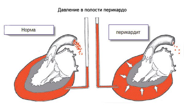 Сухой перикардит - воспаление сердечной сорочки, сопровождающееся отложением фибрина на перикарде. 