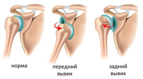 Вывихи 