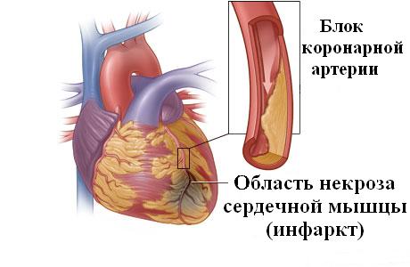 Что чувствует человек при инфаркте миокарда 