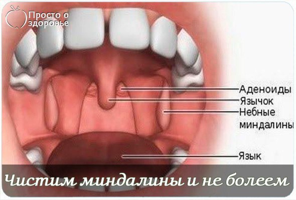 Чистим миндалины и не болеем