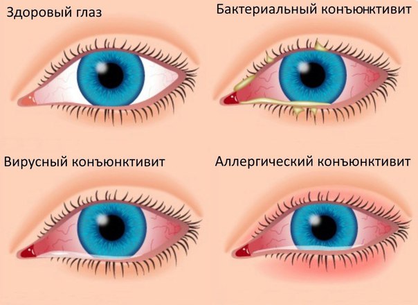 Аденовирусный конъюнктивит