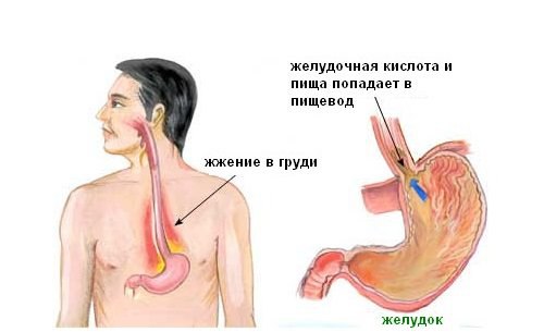 Причины появления изжоги и методы борьбы с ней 