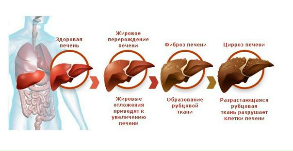 Алкогольный цирроз печени 