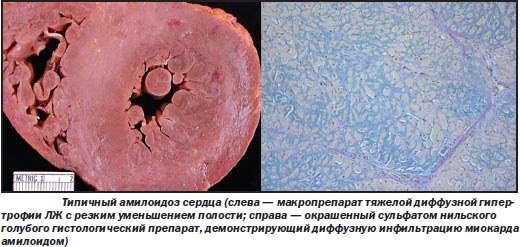 Амилоидоз сердца – системный диспротеиноз, приводящий к отложению амилоида – специфического белково-полисахаридного комплекса в тканях сердца. Амилоидоз сердца сопровождается гипертрофией миокарда, нарушением его сократительной способности, развитием хронической недостаточности кровообращения, аритмий, гипотензии, клапанных пороков. Клинический диагноз амилоидоза сердца устанавливается с помощью данных электрокардиографии, эхокардиографии, рентгенографии, сцинтиграфии, лабораторного исследования белков сыворотки крови, биопсии тканей. Лечение при амилоидозе сердца направлено на торможение амилоидогенеза (полихимиотерапия) и замедление прогрессирования сердечной недостаточности (диуретики, сердечные гликозиды, витамины). 