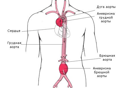 Аневризма аорты 