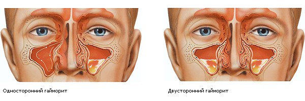 ХРОНИЧЕСКИЙ ГАЙМОРИТ 