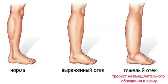 От чего возникают отеки на ногах Когда отеки говорят о болезни 