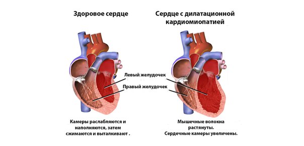 Причины ДКМП. Алкогольная кардиомиопатия 