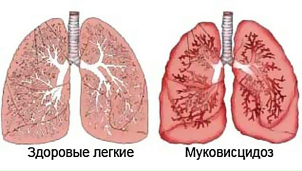Муковисцидоз (MB), легочные проявления (кистозный фиброз) — системное, генетически детерминированное заболевание экзокринной железистой ткани, передаваемое по наследству как аутосомно-рецессивный признак. Характеризуется резко повышенной вязкостью секрета слизеобразующйх желез, в том числе бронхиального дерева, обусловливающей нарушение очистительной и воздухопроводящей функций дыхательных путей. 