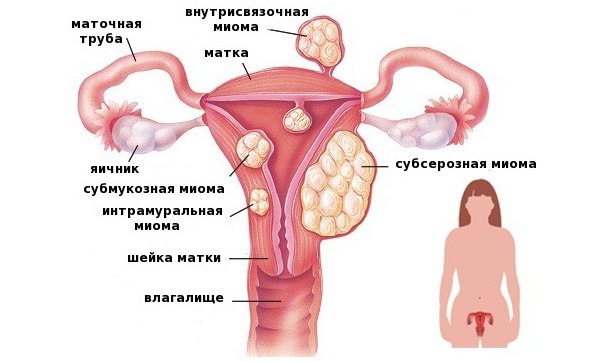 Саркома матки