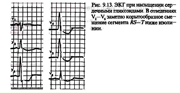 Гликозидная интоксикация 