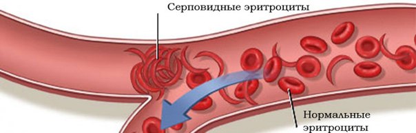 Серповидноклеточная анемия - тяжелое наследственное заболевание, связанное с патологией гемоглобина, вызывающей изменение формы и эластичности эритроцитов, клинически проявляющееся гемолитическими кризами, инфарктами внутренних органов и формированием костной и суставной патологии. 