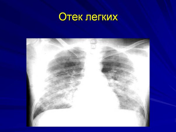 Отек легких - это избыток воды во внесосудистых пространствах легких, возникающий при нарушении механизмов, поддерживающих баланс между количеством жидкости, поступающей в легкие и покидающей их. Отек легких возникает, когда жидкость фильтруется через легочное микроциркуляторное русло быстрее, чем удаляется лимфатическими сосудами. Особенностью патогенеза отека легких по сравнению с отеком других органов является то, что транссудат преодолевает в развитии этого процесса два барьера: 1) гистогематический (из сосуда в межтканевое пространство) и 2) гистоальвеолярный (через стенку альвеол в их полость). Переход жидкости через первый барьер приводит к тому, что жидкость накапливается в интерстициальных пространствах и формируется интерстициальный отек. Когда в интерстиций поступает большое количество жидкости и поврежден альвеолярный эпителий, то жидкость проходит через второй барьер, заполняет альвеолы и формируется альвеолярный отек. Когда альвеолы наполняются, пенистая жидкость поступает в бронхи. Клинически отек легких проявляется инспираторной одышкой при напряжении и даже в покое. Одышка часто усиливается в положении лежа на спине (ортопноэ) и несколько ослабевает в положении сидя. Больные с легочным отеком могут просыпаться ночью с тяжелой одышкой (пароксизмальное ночное диспноэ). При альвеолярном отеке определяются влажные хрипы и пенистая, жидкая, с кровью мокрота. При интерстициальном отеке хрипов нет. Степень гипоксемии зависит от тяжести клинического синдрома. При интерстициальном отеке более характерна гипокапния в связи с гипервентиляцией легких. В тяжелых случаях развивается гиперкапния. 