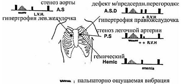 Систолический шум — это шум, выслушиваемый в период сокращения желудочков между первым и вторым тонами сердца. 