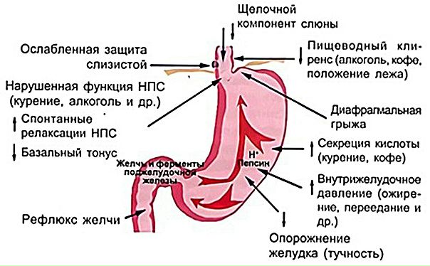 Классификация гастроэзофагеального рефлюкса