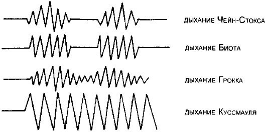 Варианты аритмичного (периодического) дыхания: 