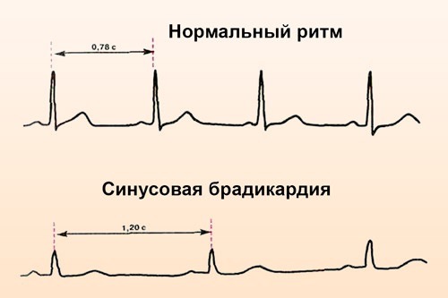 Возможные причины брадикардии: