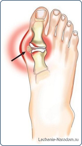 Сипмтомы подагры. Как лечить подагру