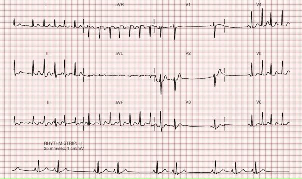 Хотите понимать подобные ЭКГшки 