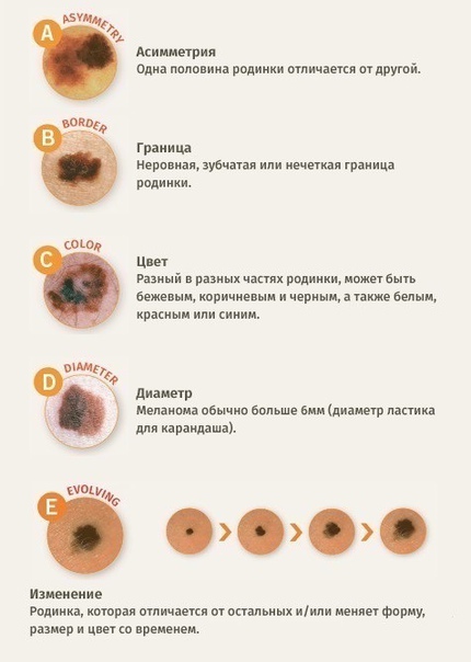 Клинические признаки, позволяющие заподозрить меланому (ABCD): 