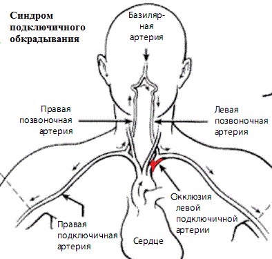 Синдром подключичного обкрадывания 