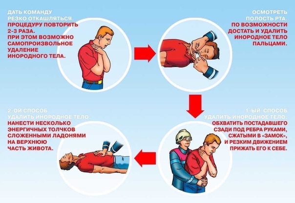 Прием Геймлиха. 