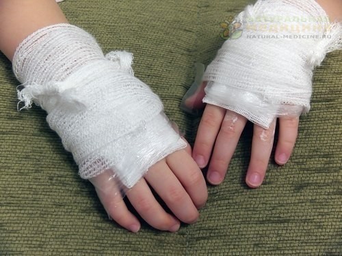 ЧТО ДЕЛАТь ПРИ ОЖОГАX 