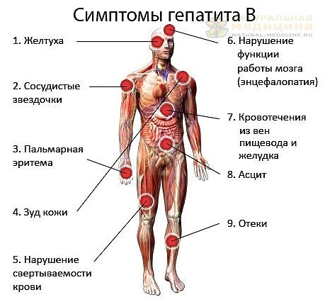  Гепатит  