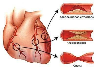 Грозит ли вам - атеросклероз 