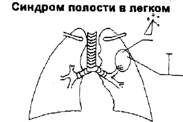 Синдром полости в легком 