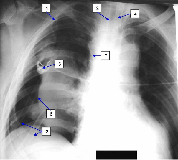 Пневмоторакс как осложнение катетеризации центральных вен