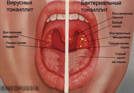 Ангина