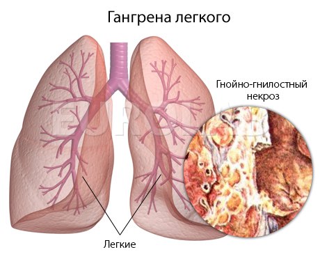 Абсцессы и гангрена легких 