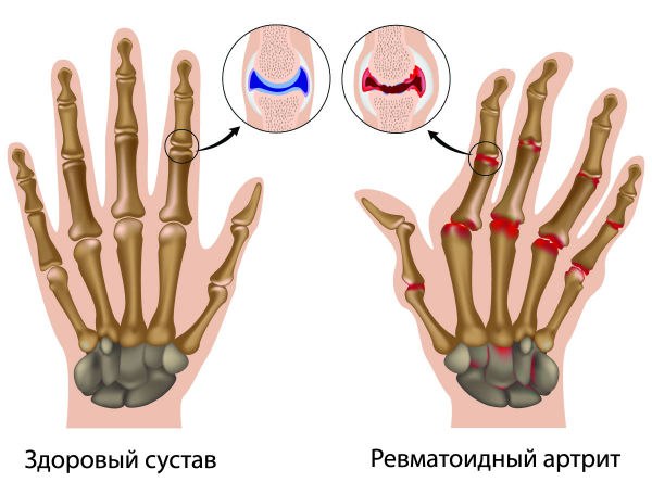 7 РАННИХ ПРИЗНАКОВ АРТРИТА 