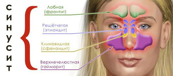 Как распознать синусит 