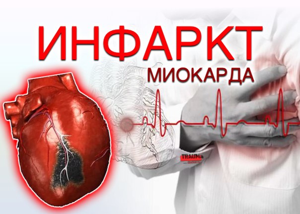  ИНФАРКТ МИОКАРДА