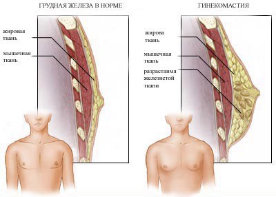 Гинекомастия - увеличение грудной железы у мужчин за счет гипертрофии и/или скопления жировой ткани. 