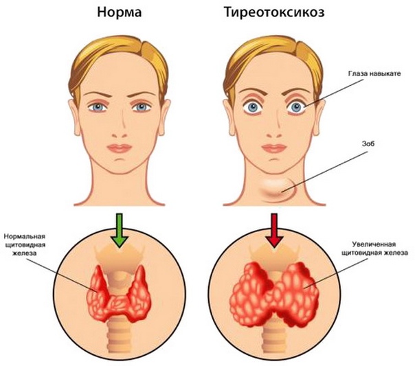 Тиреоидиты - болезни щитовидной железы, различные по этиологии и патогенезу. Воспаление диффузно увеличенной щитовидной железы называют струмитом. 