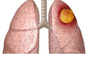Абсцесс лёгкого - развивающаяся вследствие нагноения полость в лёгком, заполненная гноем и отграниченная от окружающих тканей грануляционной тканью и слоем фиброзных волокон.