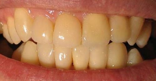 Эксперты рассказали, о чем говорит желтый цвет зубов