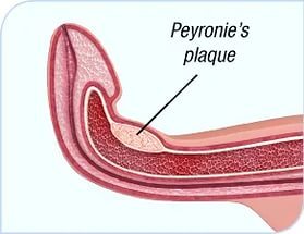 Болезнь Пейрони Болезнь Пейрони